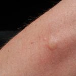 Hoe reageert mijn huid op muggensteken?