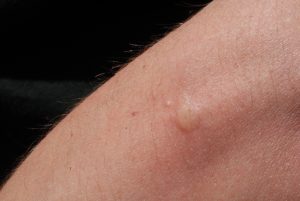 Lees meer over het artikel Hoe reageert mijn huid op muggensteken?