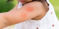 Grote muggenbulten, wanneer spreek je van een allergische reactie?