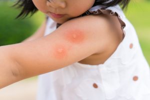 Lees meer over het artikel Allergisch zijn voor muggenbeten, kan dat?